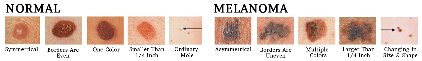 Examples Of Skin Cancer Types