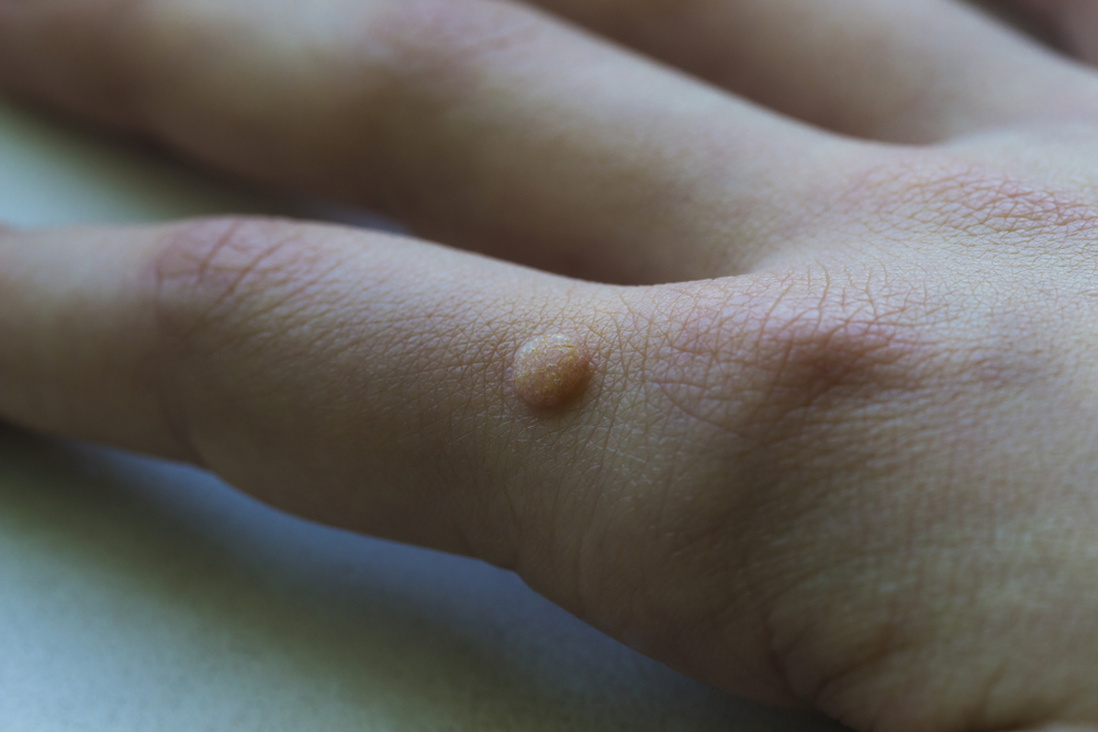warts on hands are caused by)
