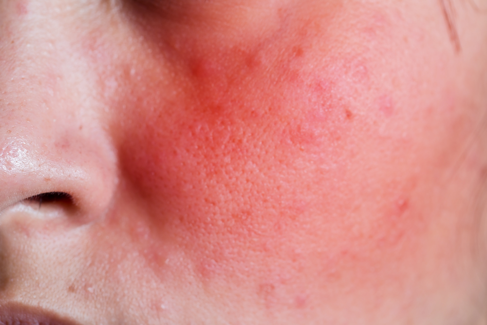 Common Skin Conditions That Cause Facial Redness Fldscc