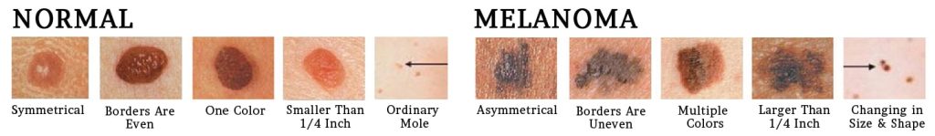 skin cancer treatment