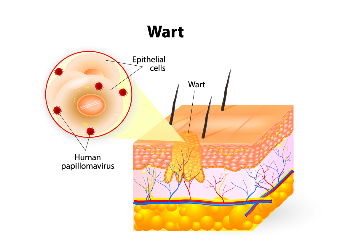 Warts