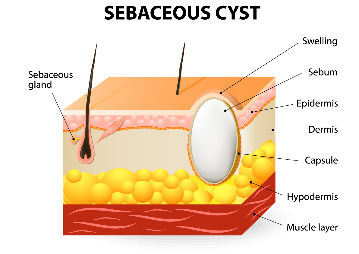 Cysts