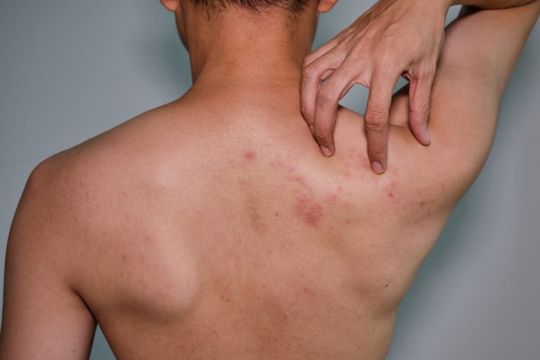 Eczema, Psoriasis & Shingles FLDSCC