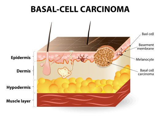 Melanoma, Basal Cell - FLDSCC