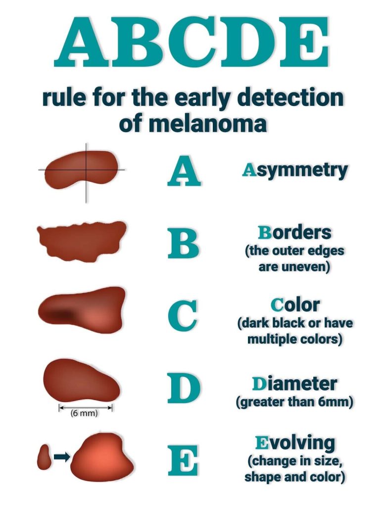 Melanoma