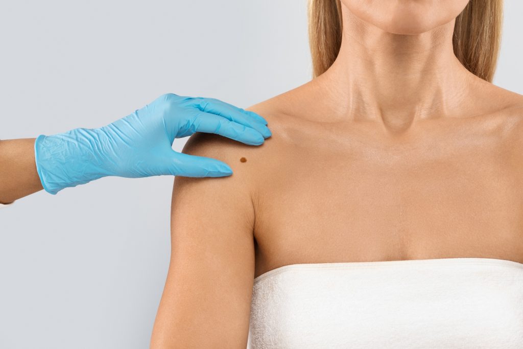 Skin Cancer