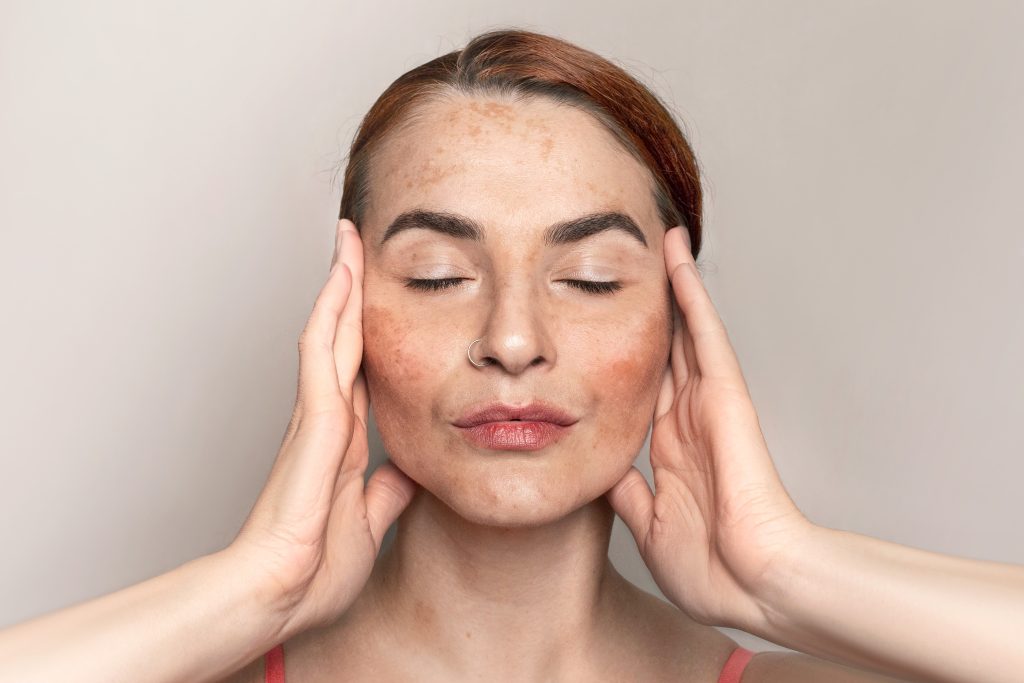 Melasma